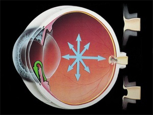 glaucoma-img