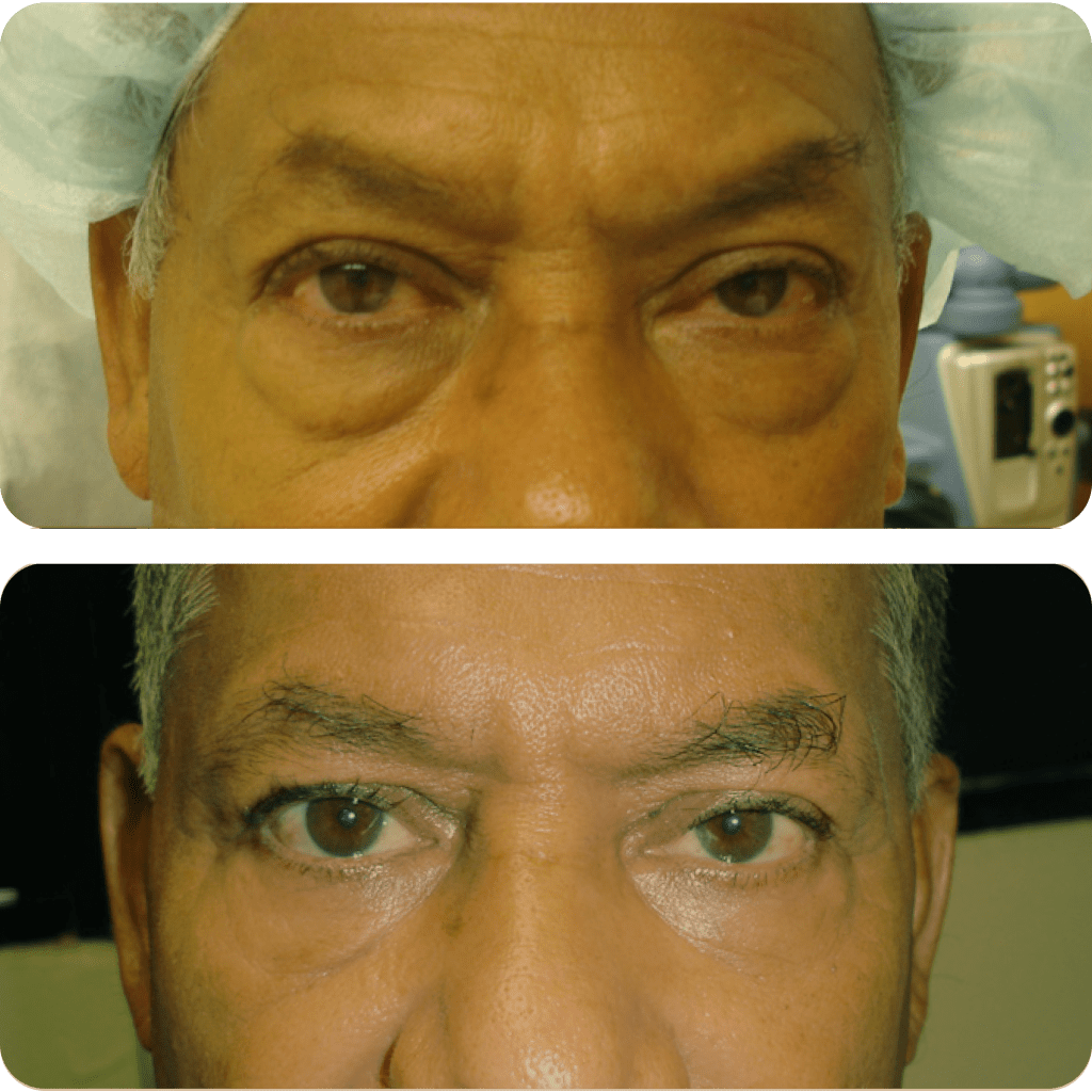 Lower Blepharoplasty at Eye Care Clinic in Los Angeles - St. Lucia Eye Center