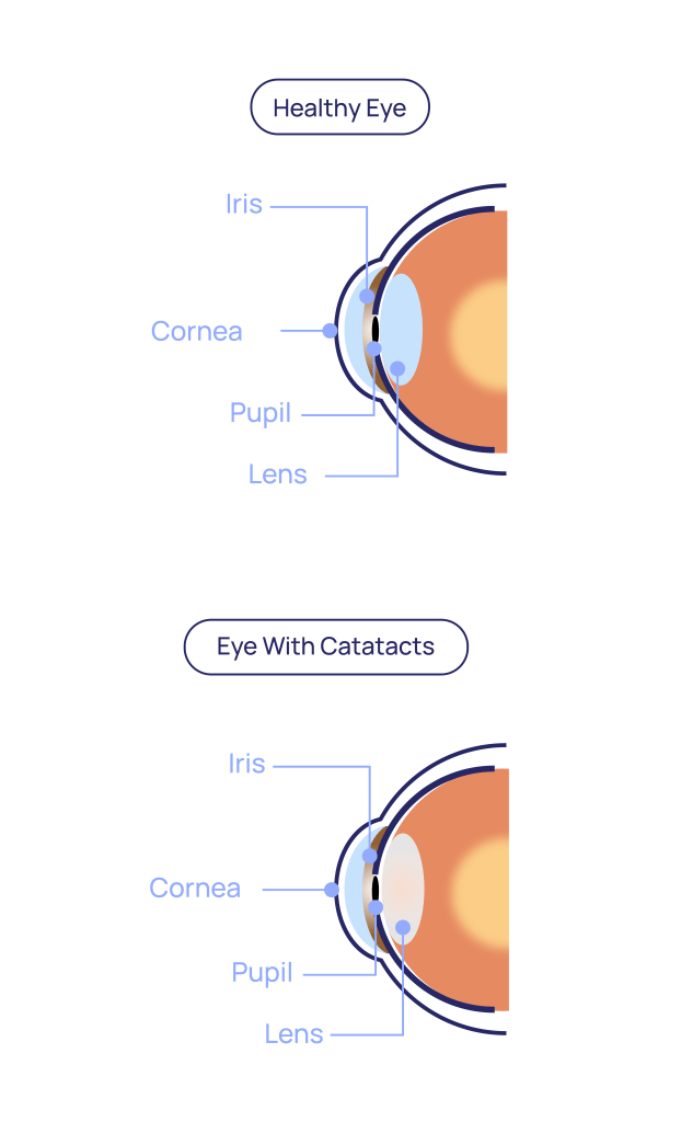 Cataracts at Eye Care Clinic in Los Angeles - St. Lucia Eye Center