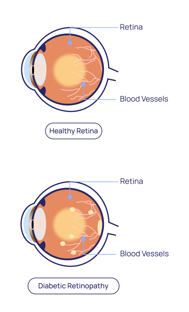 Diabetic Retinopathy at Eye Care Clinic in Los Angeles - St. Lucia Eye Center