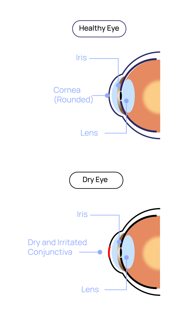 Dry Eye Treatment at Eye Care Clinic in Los Angeles - St. Lucia Eye Center