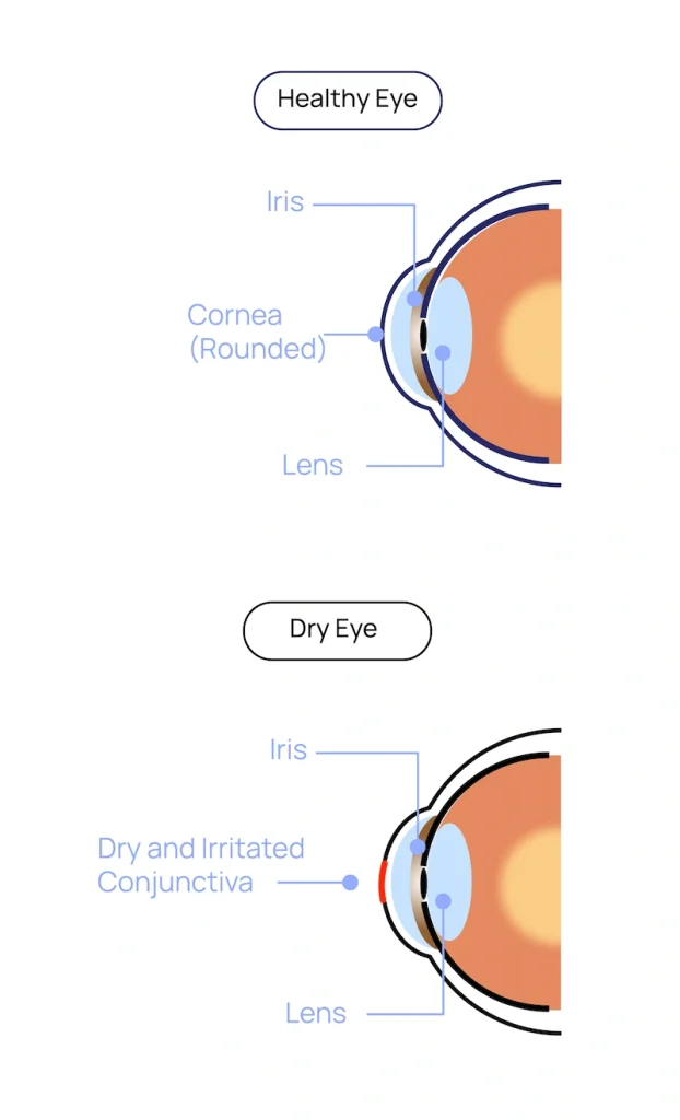 Dry Eye Treatment at Eye Care Clinic in Los Angeles - St. Lucia Eye Center