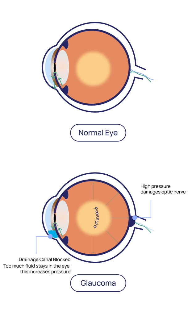 Glaucoma at Eye Care Clinic in Los Angeles - St. Lucia Eye Center