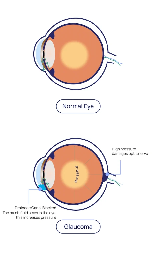 Glaucoma at Eye Care Clinic in Los Angeles - St. Lucia Eye Center