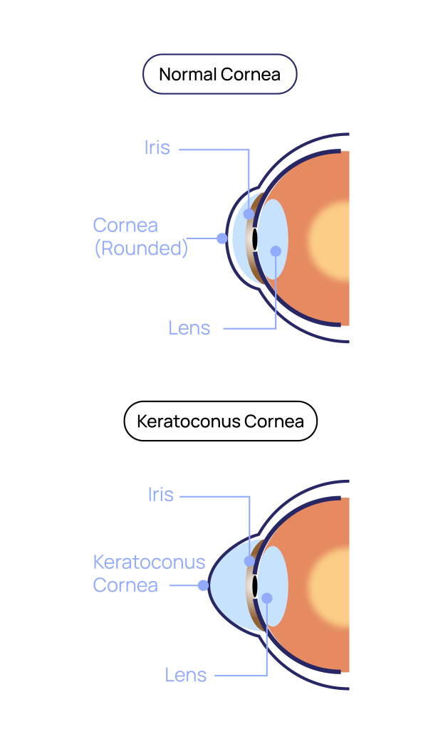 Keratoconus at Eye Care Clinic in Los Angeles - St. Lucia Eye Center