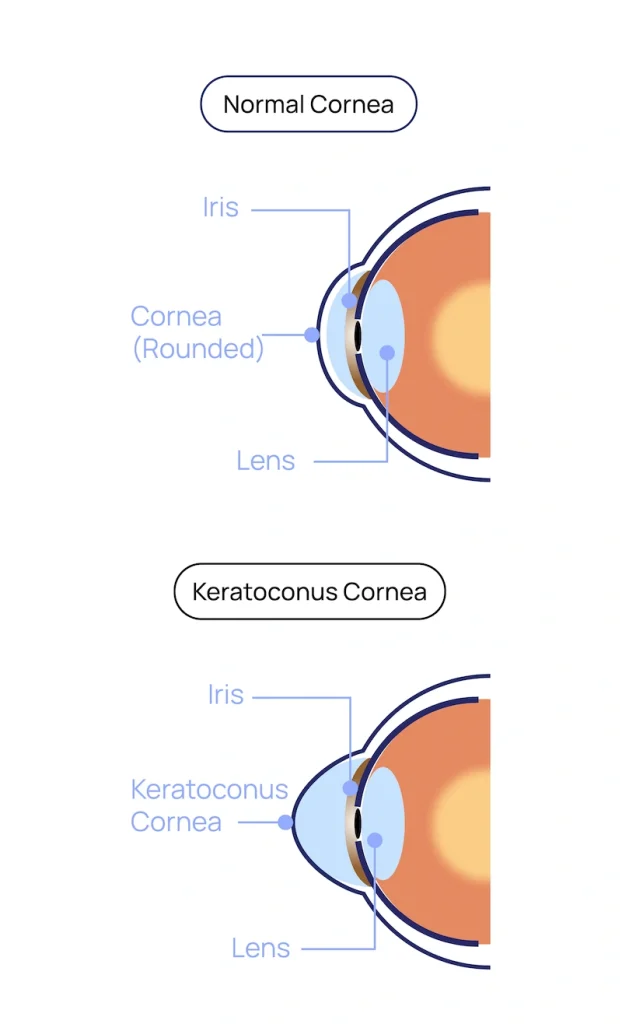 Keratoconus at Eye Care Clinic in Los Angeles - St. Lucia Eye Center