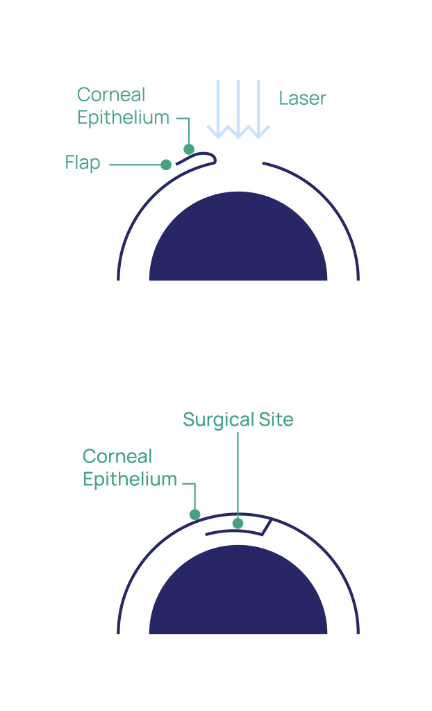 LASIK at Eye Care Clinic in Los Angeles - St. Lucia Eye Center