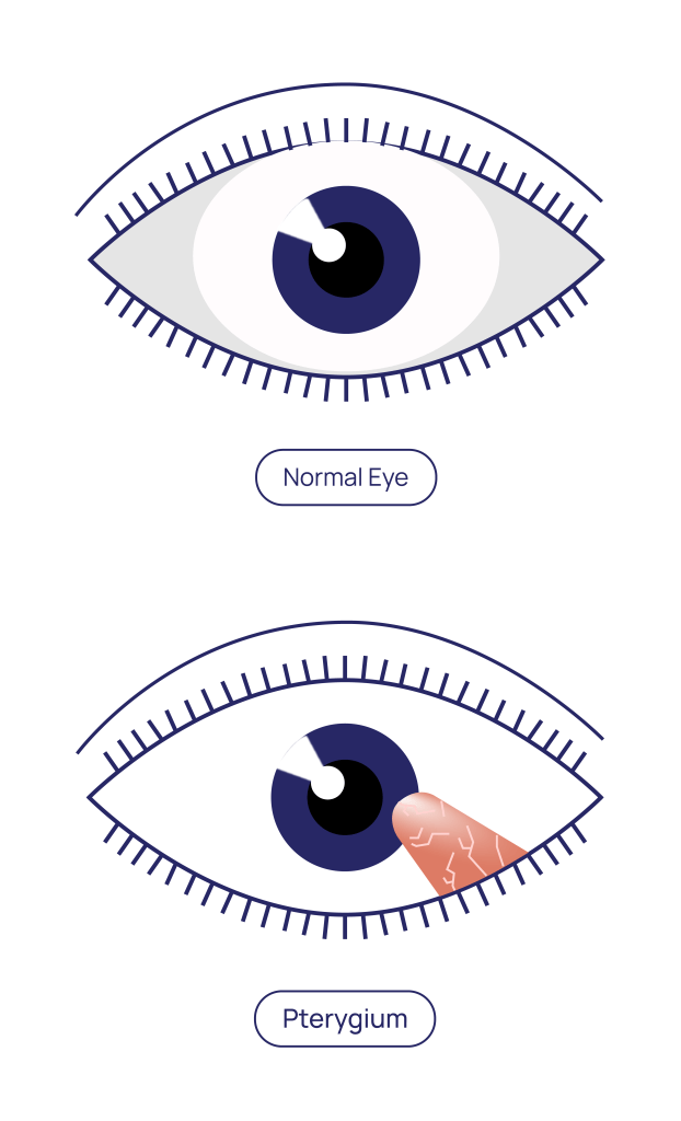 Pterygium Procedure at Eye Care Clinic in Los Angeles - St. Lucia Eye Center