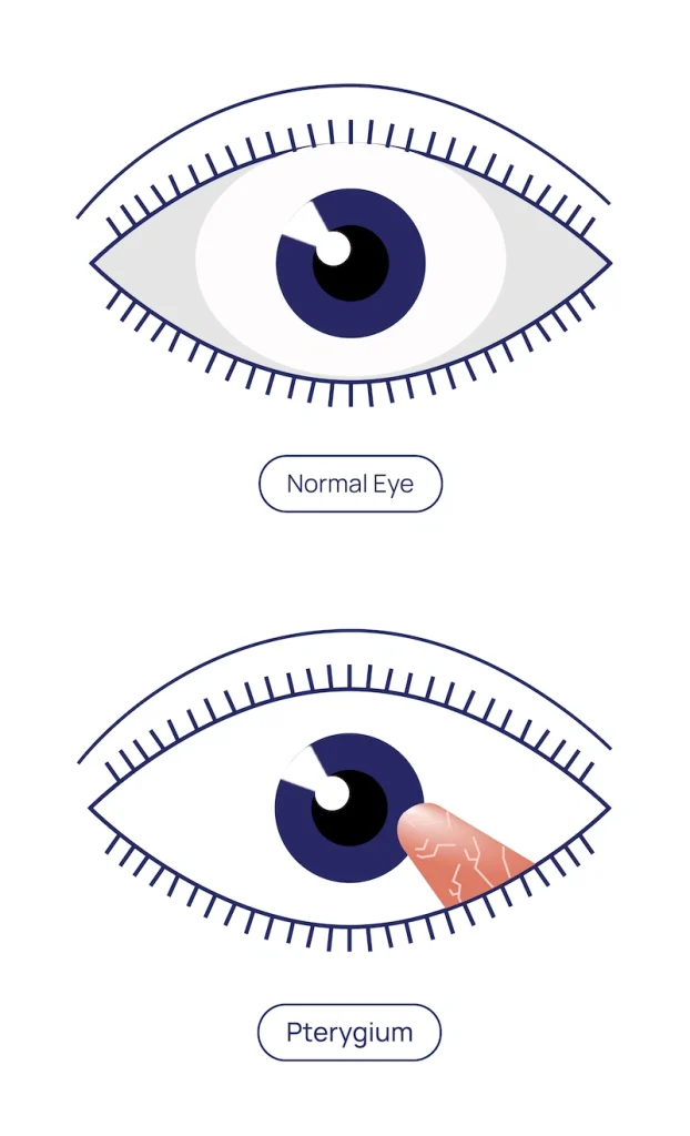 Pterygium Procedure at Eye Care Clinic in Los Angeles - St. Lucia Eye Center