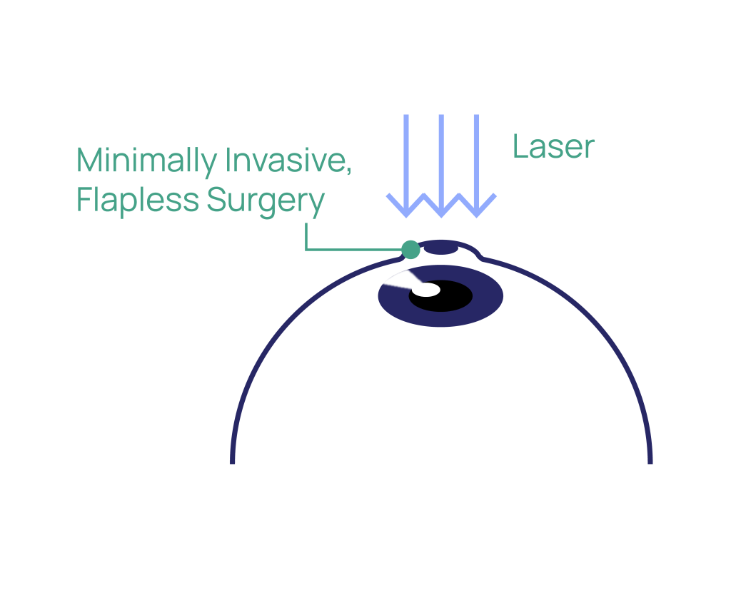 SMILE at Eye Care Clinic in Los Angeles - St. Lucia Eye Center