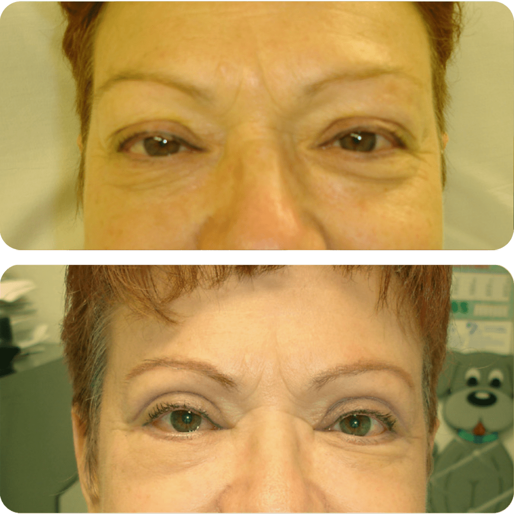 Upper Blepharoplasty at Eye Care Clinic in Los Angeles - St. Lucia Eye Center